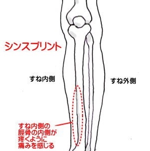 シンスプリント　画像