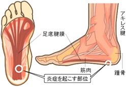 足の裏　痛む　画像